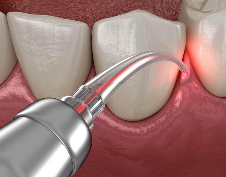 Gum correction surgery performed with a laser at a dental clinic in Stafford, VA