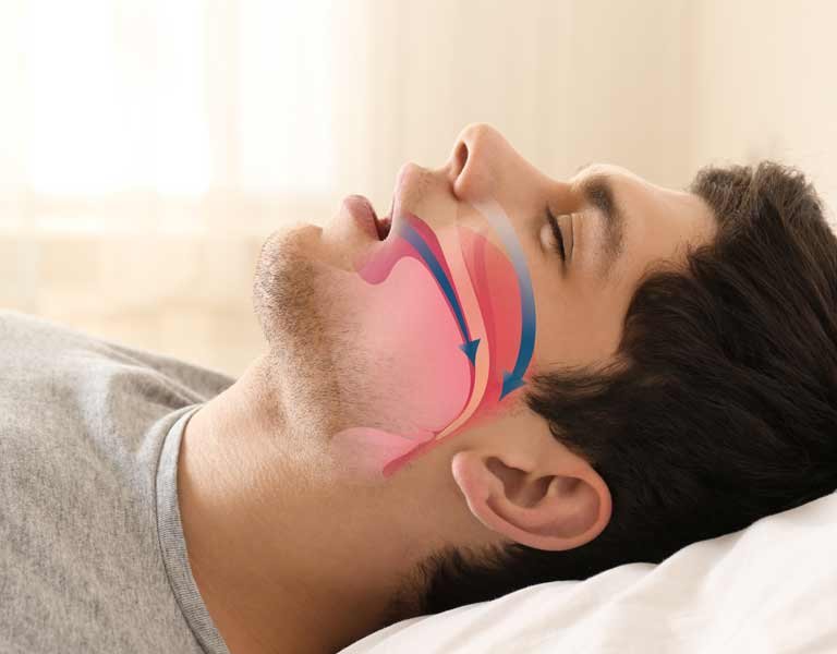 Medical illustration showing obstructive sleep apnea in Stafford, VA